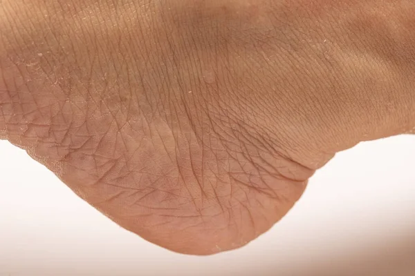 Nahaufnahme Trockener Haut Der Ferse Des Menschlichen Fußes — Stockfoto