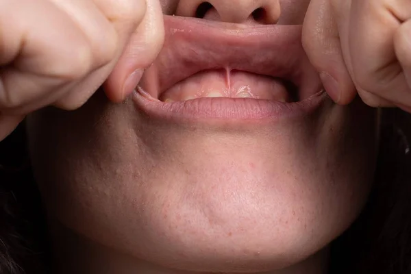 Detail of female mouth with upper lip pulled upwards with fingers