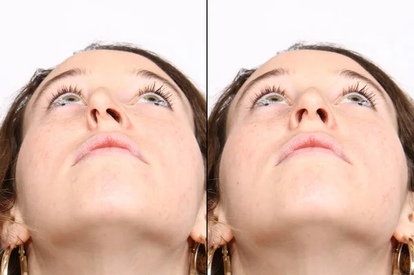 Comparison Outcomes Nose Reconstruction — Stock Photo, Image