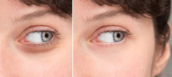 Dois Olhos Menina Mostrando Resultados Blefaroplastia Para Eliminar Sacos Oculares — Fotografia de Stock