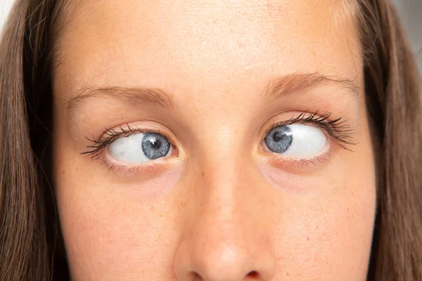 Mujer Ojos Que Sufren Estrabismo — Foto de Stock