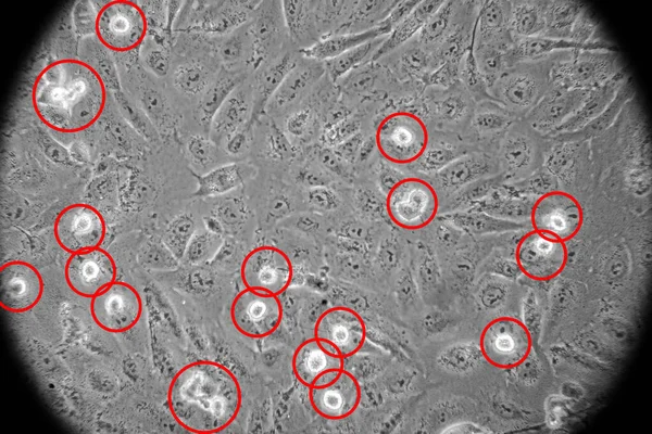 人癌细胞科学研究 — 图库照片