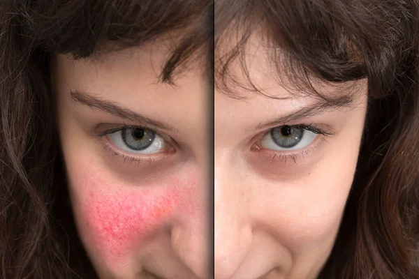 Cuando Enrojecimiento Facial Patológico Antes Después Del Tratamiento Rosácea — Foto de Stock