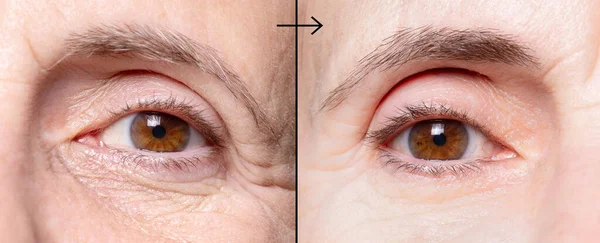 Olhos Mulher Enrugada Antes Depois Tratamento Antienvelhecimento — Fotografia de Stock