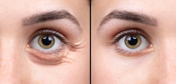 Collage Vistas Cerca Los Ojos Las Mujeres Comparación Antes Después —  Fotos de Stock