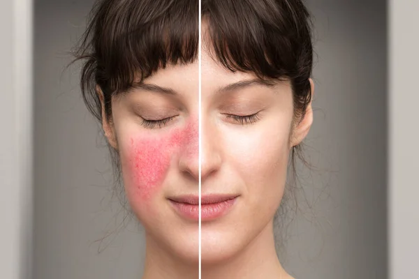 Tecken Och Symtom Rosacea Naturliga Botemedel Vid Behandling Hudsjukdomar — Stockfoto