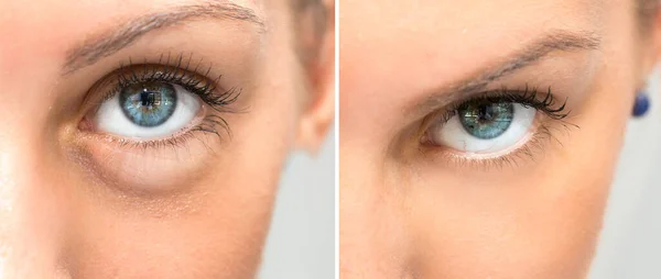 Kolaż Dwóch Oczu Pokazuje Różnicę Zastosowaniu Kosmetyku — Zdjęcie stockowe