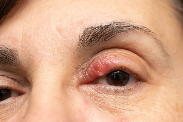 開いた女性の目で赤と腫れたチャリオンのビューを閉じます ウイルス感染による上まぶたの炎症の閉鎖 白人女性 医学と医療の概念 — ストック写真