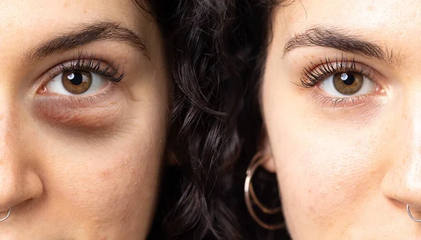 Hautpflege Hautunreinheiten Gesicht Seite Seite Vergleich — Stockfoto