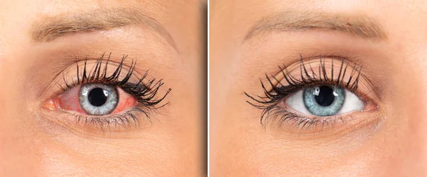 Frau Rote Augen Vor Und Nach Augentropfen Behandlung — Stockfoto