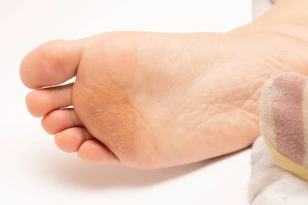 Callus under the sole of the foot, concept of skin care and care for the female body