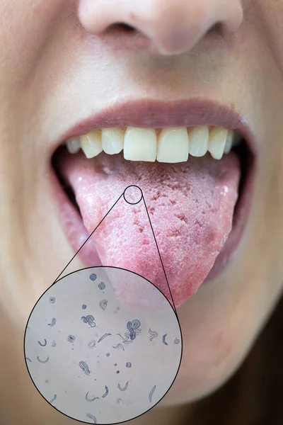 Langue Avec Fissures Infection Bactérienne Avec Vue Microscopique — Photo