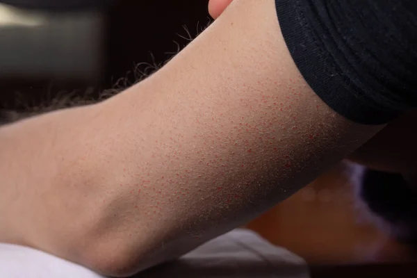Keratoz pilaris belirtileri gösteren akneiform rosacea semptomlarına benzer kırmızımsı lekeler gösteren bir kadın kolu.