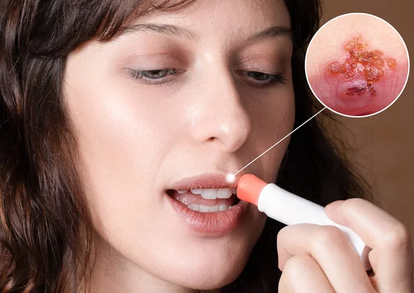 Antiviral treatment for cold sores, a girl is having a cycle of therapy with a lip stick