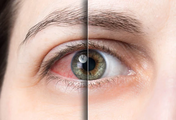 Olho Vermelho Antes Depois Tratamento — Fotografia de Stock