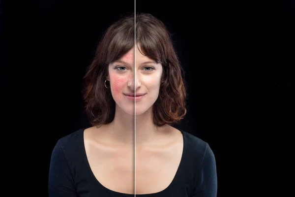 Rosacea, siyah arka planda izole edilmiş lazer terapisiyle ortadan kaldırılmadan önce ve sonra tatlı bir kızın yüzünde.