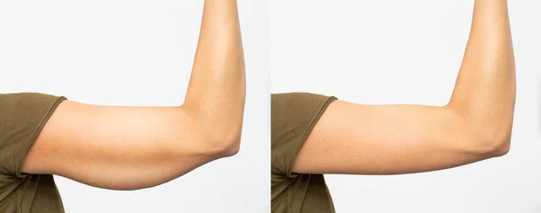 Excess Skin Removal Arm — Stock Photo, Image