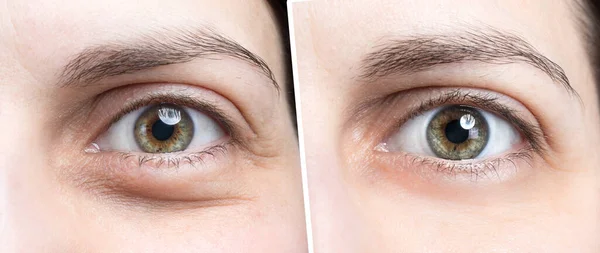 Πρησμένο Μάτι Γυναίκας Πριν Και Μετά Θεραπεία Μπότοξ — Φωτογραφία Αρχείου