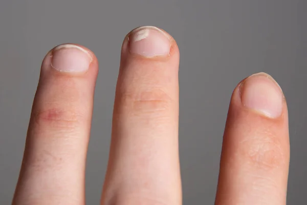 Leukonychia Witte Vlekken Nagels Calcium Vitamine Deficiëntieconcept — Stockfoto