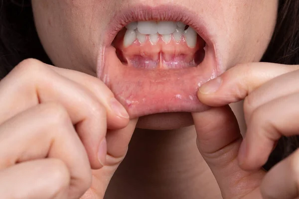 Tandvleesproblemen Bij Zwangere Vrouwen Hoe Kunnen Symptomen Worden Verlicht — Stockfoto