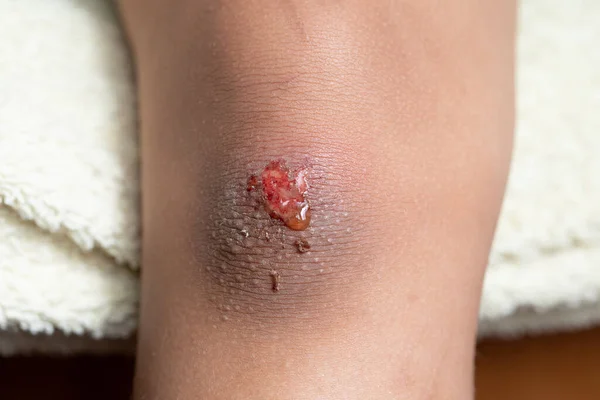 Fresh skin wound on the scraped knee of a child