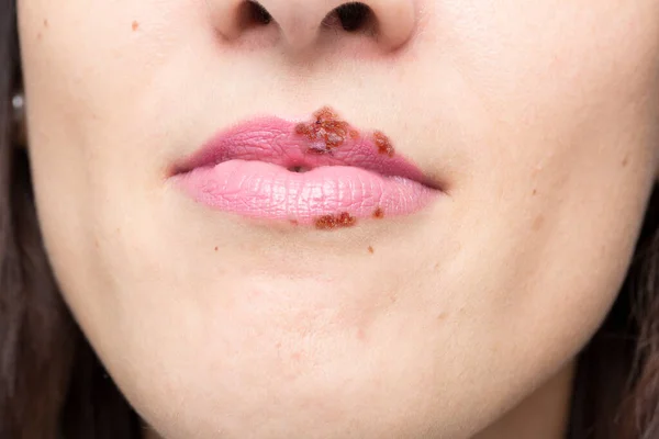 Tutto Quello Che Dovreste Sapere Herpes Simplex Concetto Virus — Foto Stock