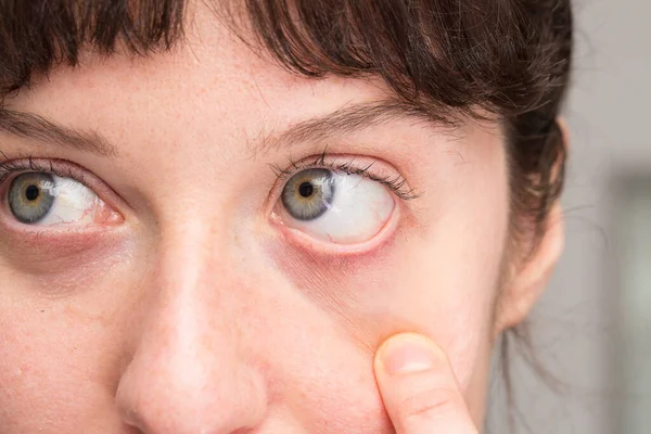 Woman with disease in her eye