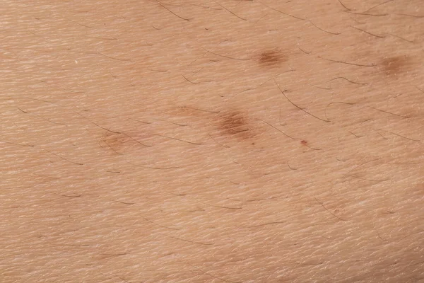 シミ付きの乾燥肌 マクロ画像 — ストック写真