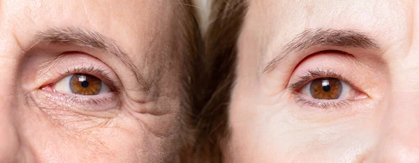 Arrugas Bajo Los Ojos Antes Después Del Tratamiento Con Botox —  Fotos de Stock