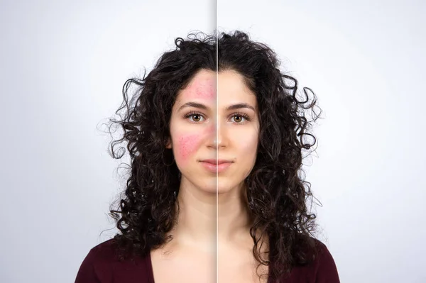 Collage Comparing Healthy Skin Face Suffering Rosacea Visible Blood Vessels — Stock Photo, Image