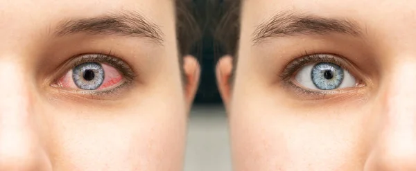 Comparação Vista Perto Olho Antes Depois Tratamento Com Colírio Olho — Fotografia de Stock