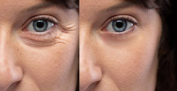 Woman Eyes Age Treatment Wrinkles Crow Feet — Stock Photo, Image