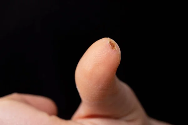 Процесс Заживления Небольшой Раны Большом Пальце Взрослого Пациента Мужчины Концепция — стоковое фото