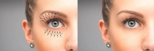 Oczy Kobiety Przed Blepharoplastyce — Zdjęcie stockowe
