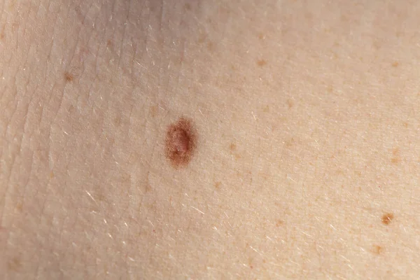 Macro of brown skin mole on a girl's back