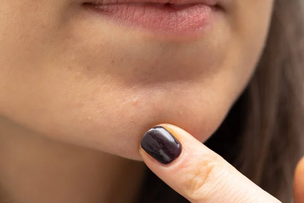 A closeup view of a Caucasian woman pointing towards a small blemish on her chin, dermatology and beauty concept.