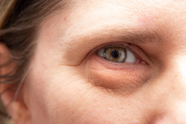 Closeup of wrinkles and heavy puffiness in the eye region of a middle aged woman. Plastic surgery concept