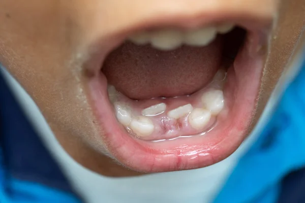 Dwurzędowe Usuwanie Zębów Dziecka — Zdjęcie stockowe
