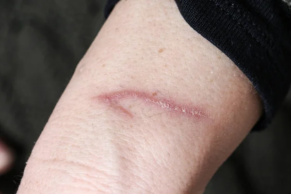 Fechar Cicatriz Queimadura Cura Antebraço Humano — Fotografia de Stock