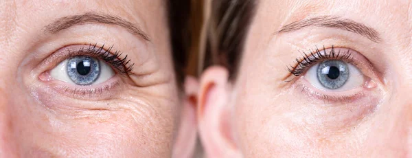 Collage Comparison Beauty Care Closeup View Aged Women Eyes — Stock Photo, Image