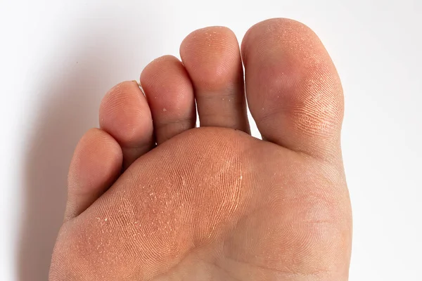 Detail Der Rauen Haut Von Erwachsenen Und Der Fußkornmuschel Schuhproblem — Stockfoto
