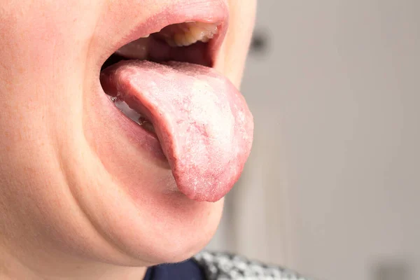 Tongue Oral Trush Caused Candida Albicans — Stock Photo, Image