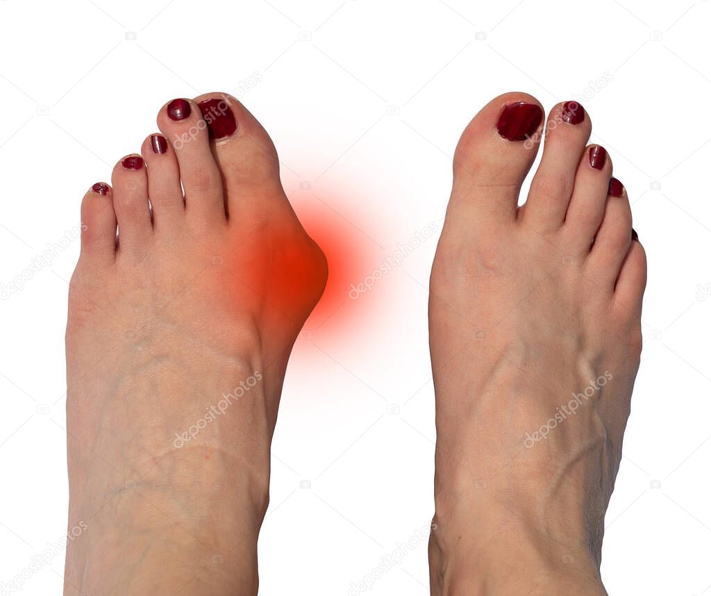 Hallux valgus, bunion in female feet on white background