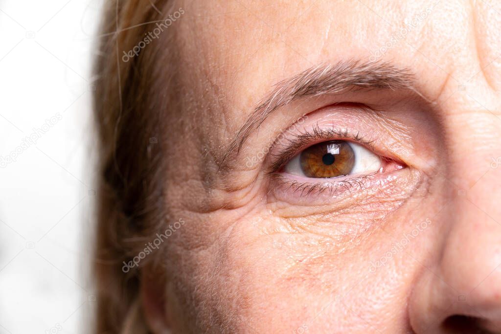 Woman wrinkled eye with crow'sfeet and under eye bags