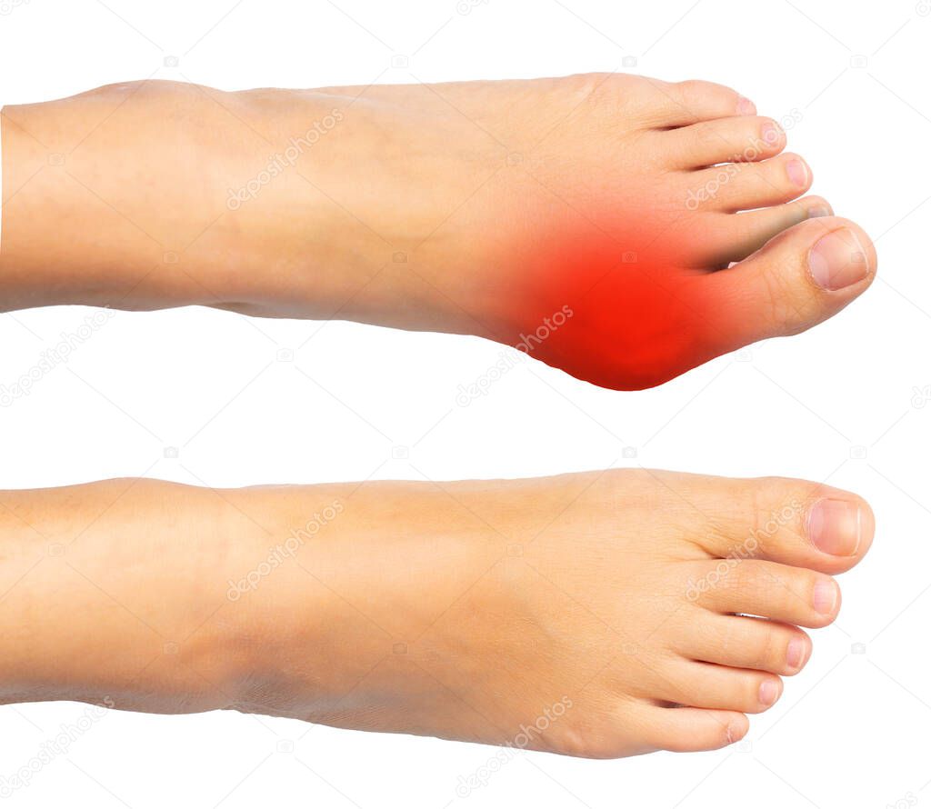 Comparison between a hallux valgus foot and a healthy foot, the painful area highlighted in red