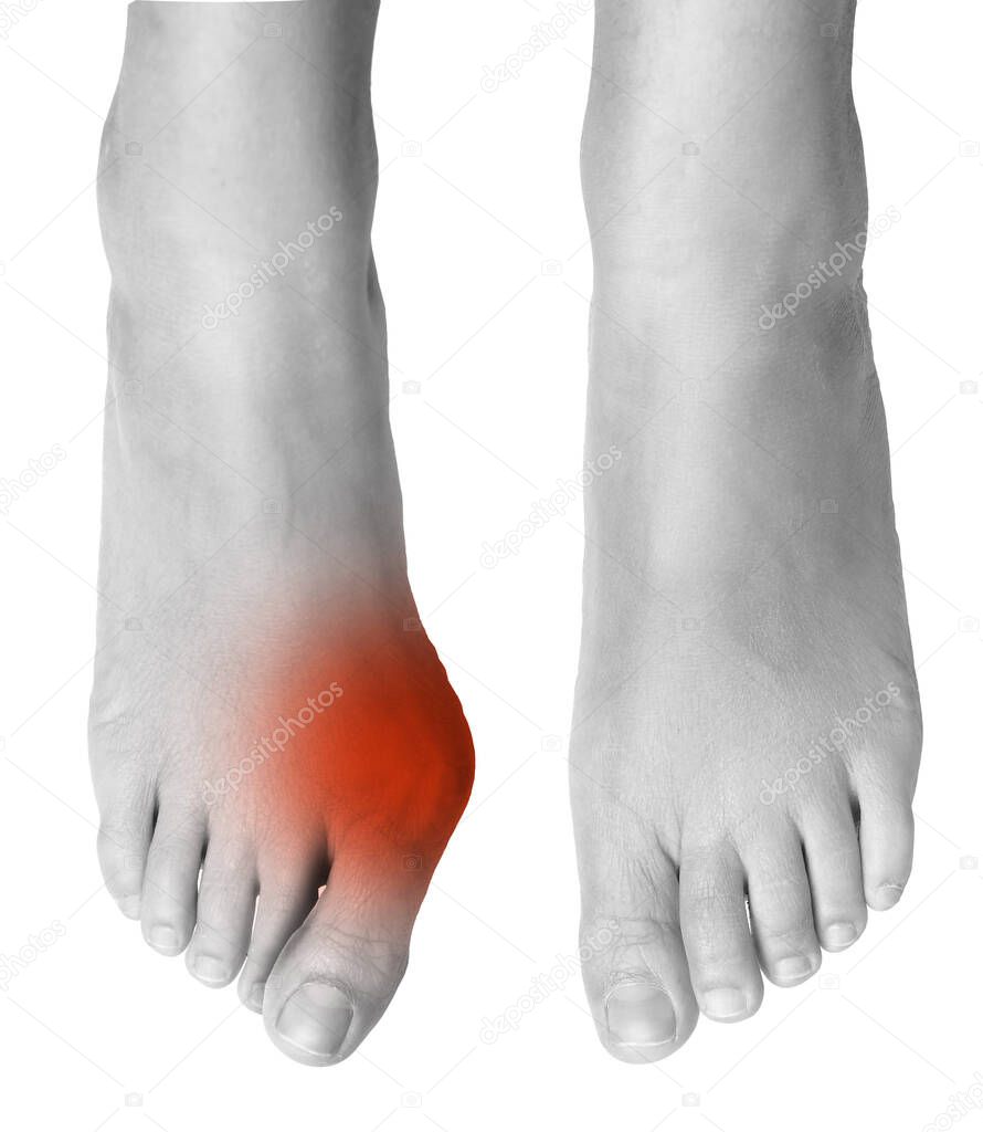 Comparison between a hallux valgus foot and a healthy foot, the painful area highlighted in red, black and white image