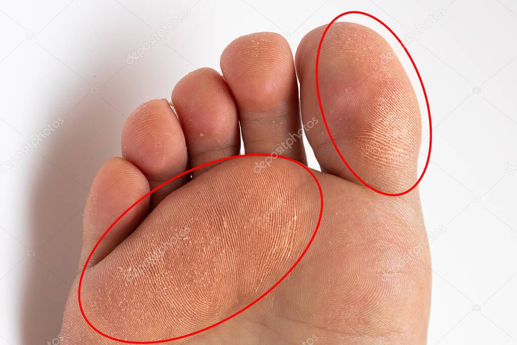 Sole of a woman's foot with thick corns highlighted by red circles