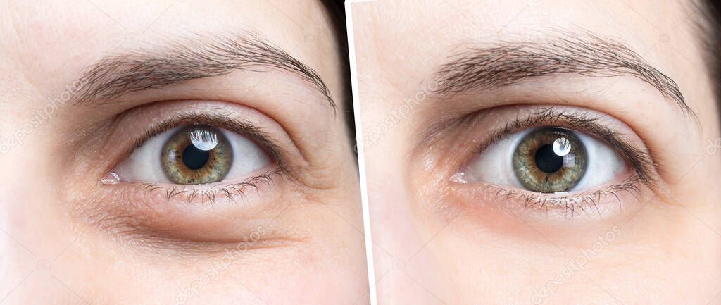 Swollen eye of woman before and after botox treatment