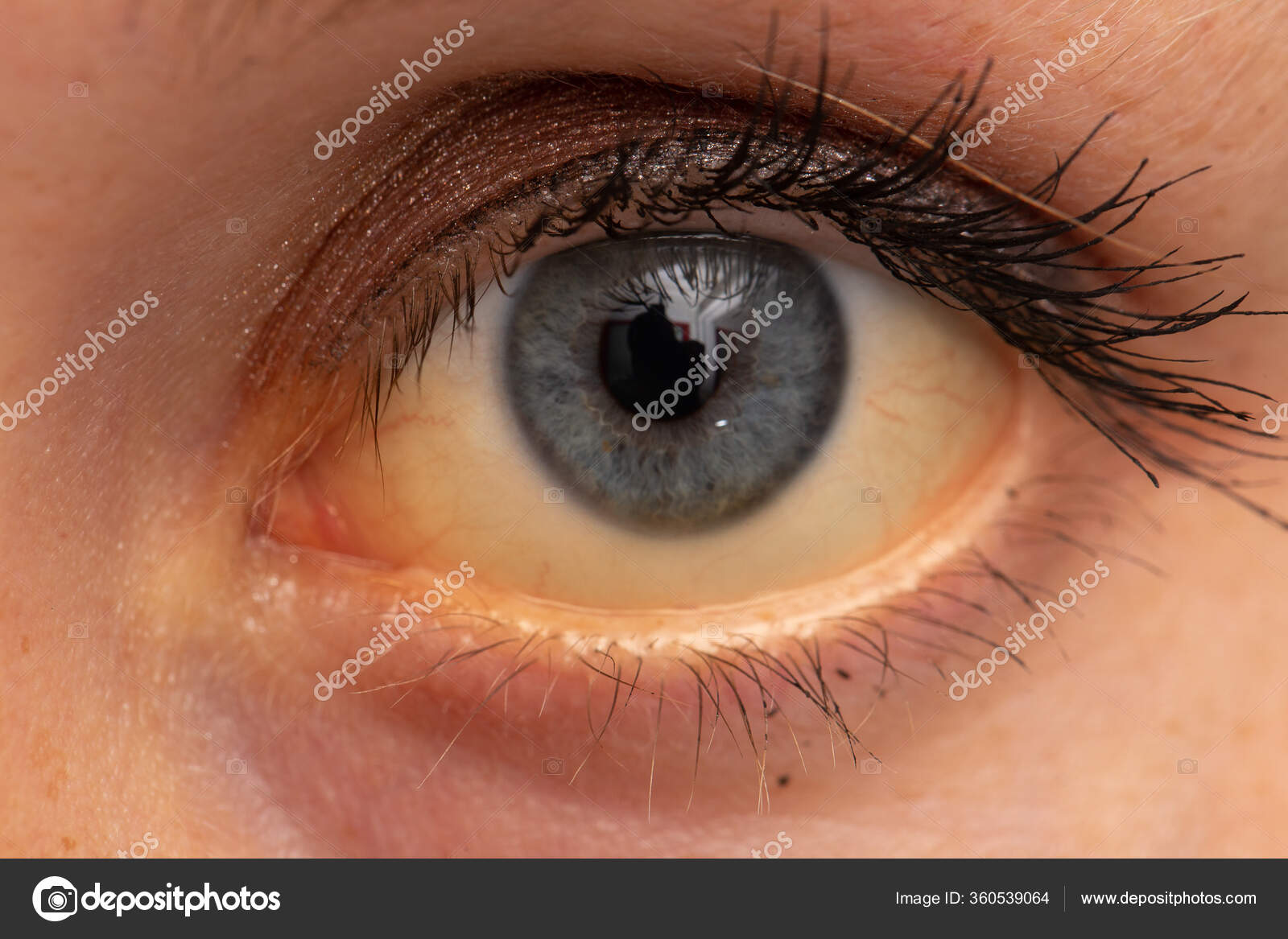 причины желтых глаз у женщин