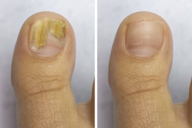 Onychomycosis 'ten muzdarip olan bir kişinin ayak başparmağında mantar tedavisi öncesi ve sonrası görülmektedir, mantar enfeksiyonu ayak tırnağının sararmasına neden olur..